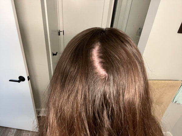 Hair That's Visibly Thinning at the Part Line and Crown