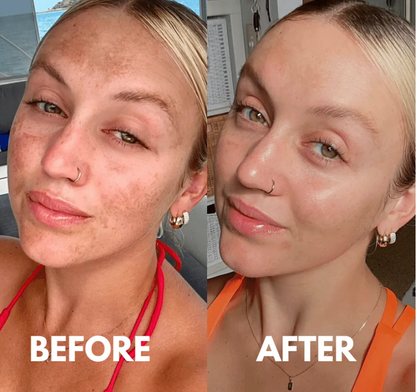 Nivoro™ - Tx Cream