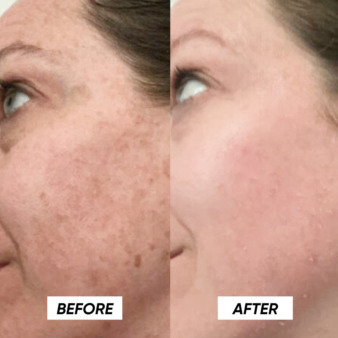 Nivoro™ - Tx Cream