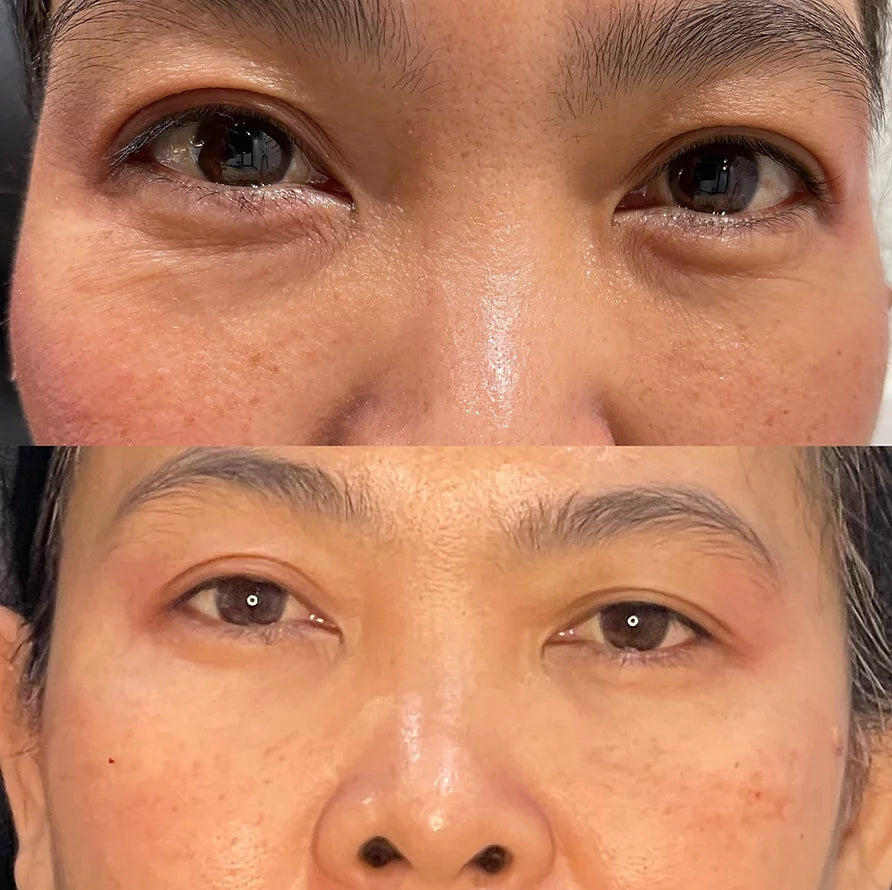 Nivoro™ - Collagen Hydrogel Eye Patch