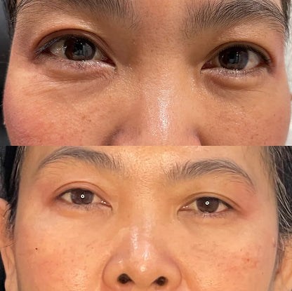 Nivoro™ - Collagen Hydrogel Eye Patch