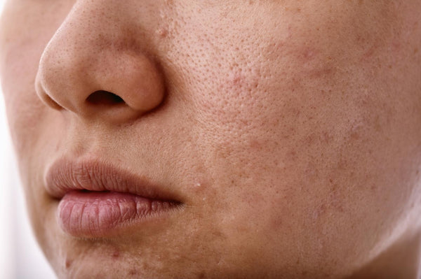 Dull, Uneven Skin That Won't Respond to Topicals